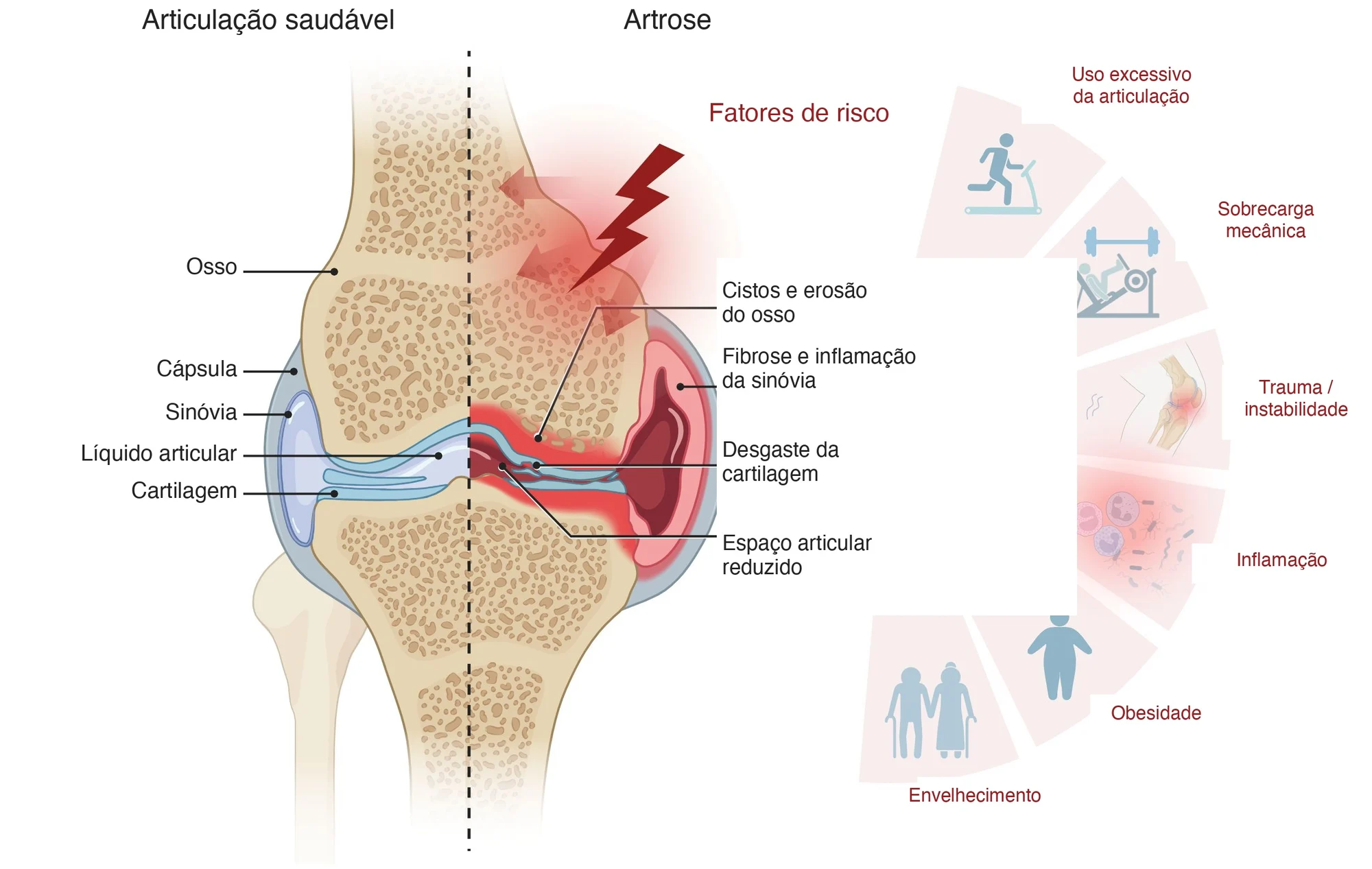 Comparação anatômica de uma articulação: à esquerda a saudável, com cartilagem íntegra, cápsula, sinóvia e líquido articular; à direita a mesma articulação com artrose, com cartilagem desgastada, espaço articular reduzido, cistos no osso e inflamação da sinóvia