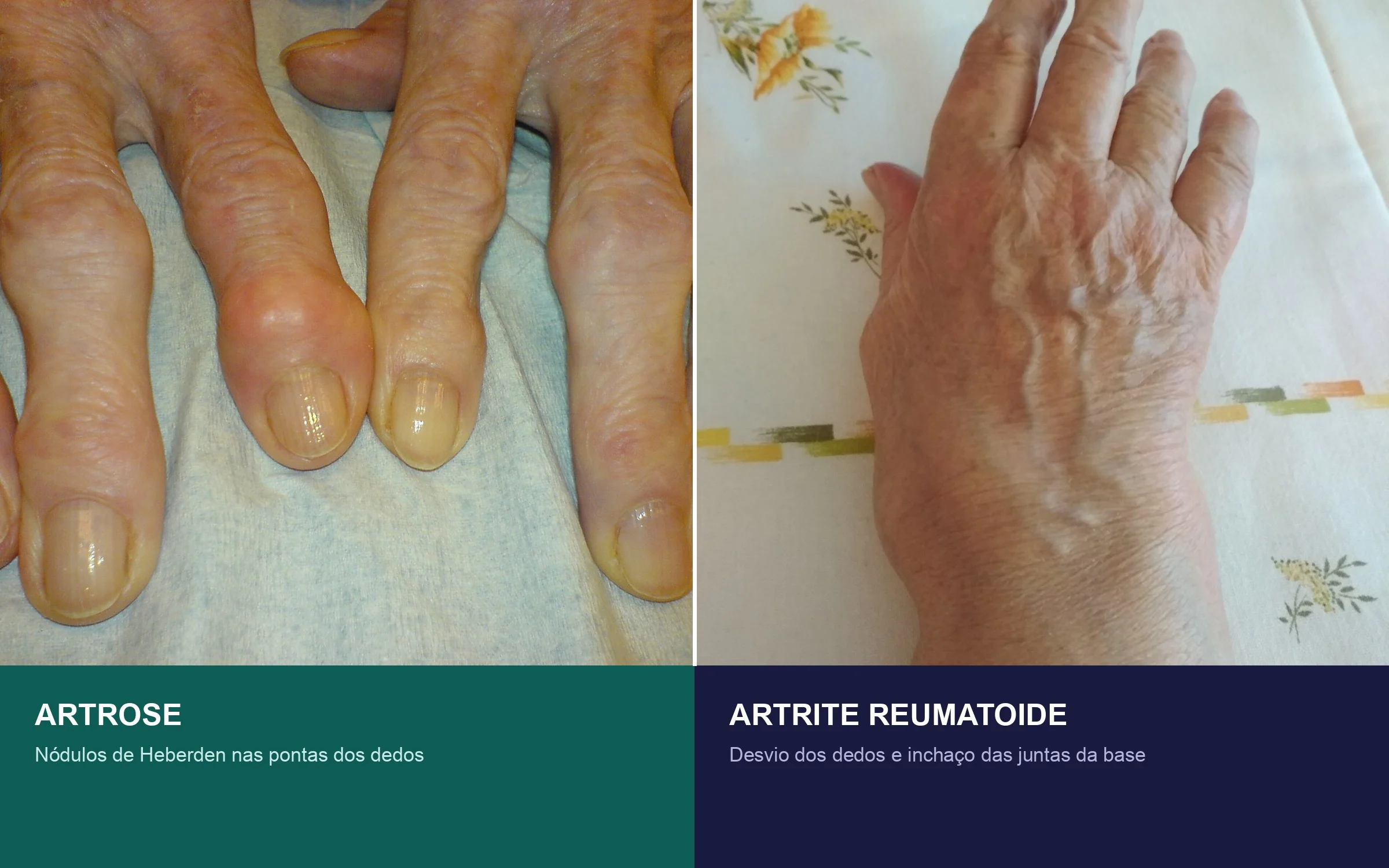 Comparação lado a lado: à esquerda, mão com nódulos de Heberden nas pontas dos dedos (artrose); à direita, mão com desvio dos dedos e inchaço das juntas da base (artrite reumatoide)