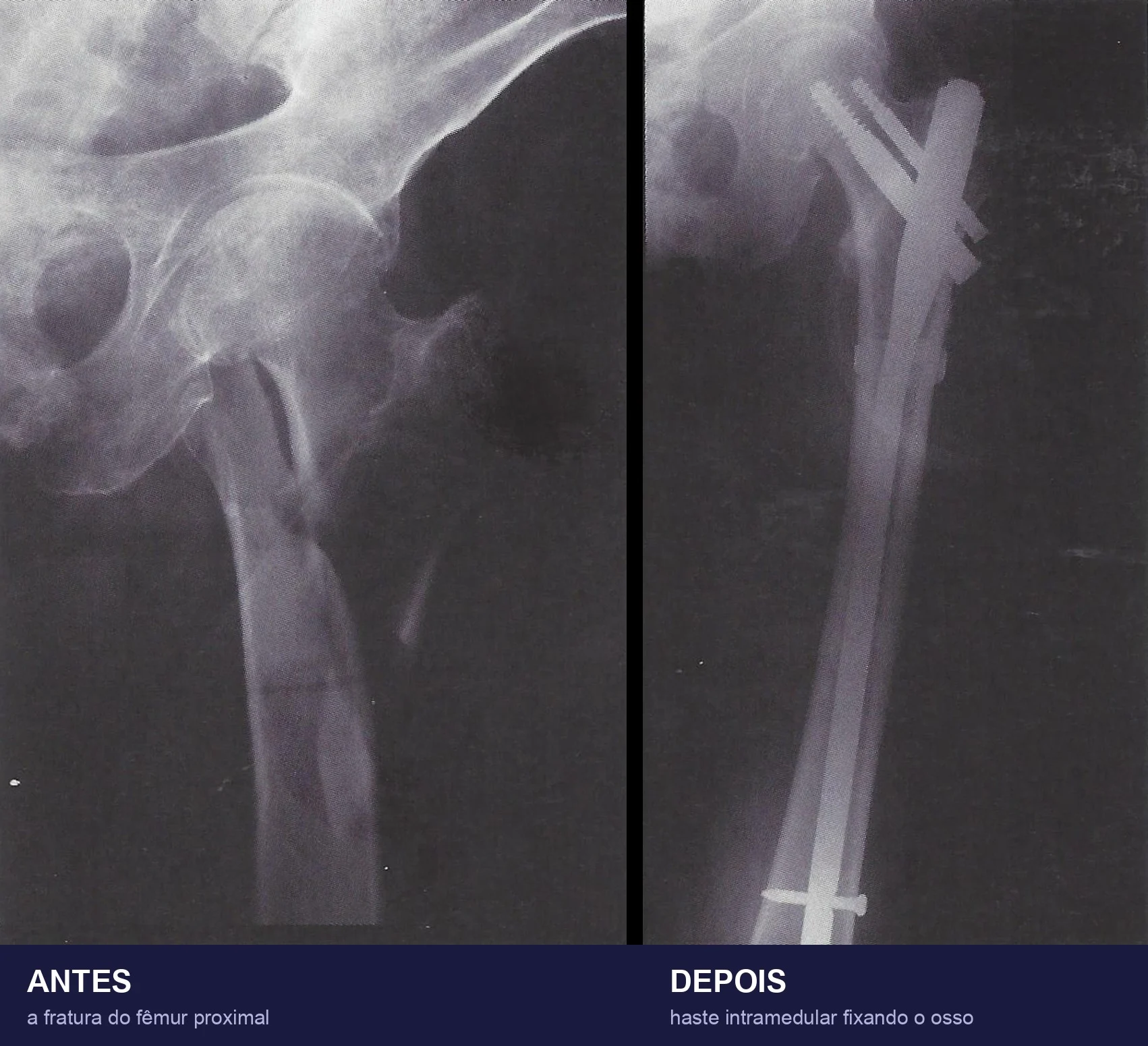 Duas radiografias do fêmur lado a lado: à esquerda, antes, o traço da fratura no fêmur proximal; à direita, depois, a haste intramedular fixando o osso