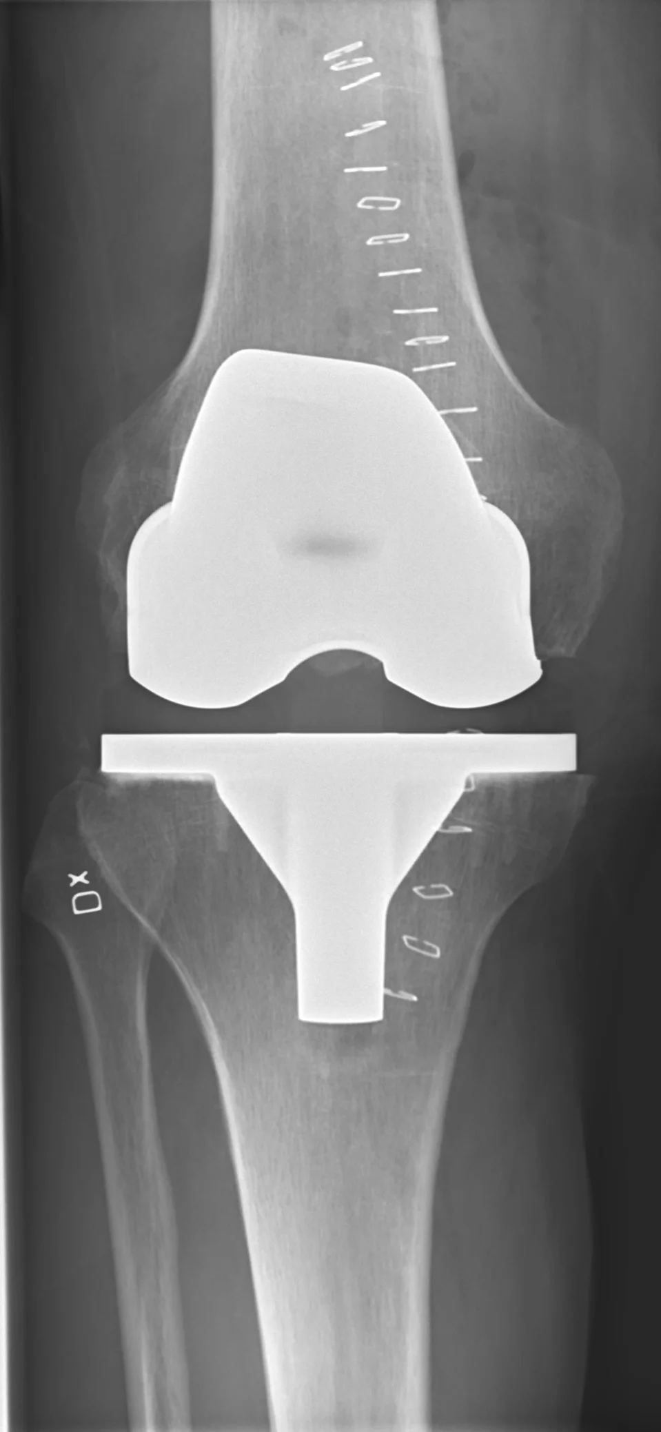 Radiografia de joelho de frente após a cirurgia, mostrando a prótese total instalada: componente metálico sobre o fêmur e base sobre a tíbia