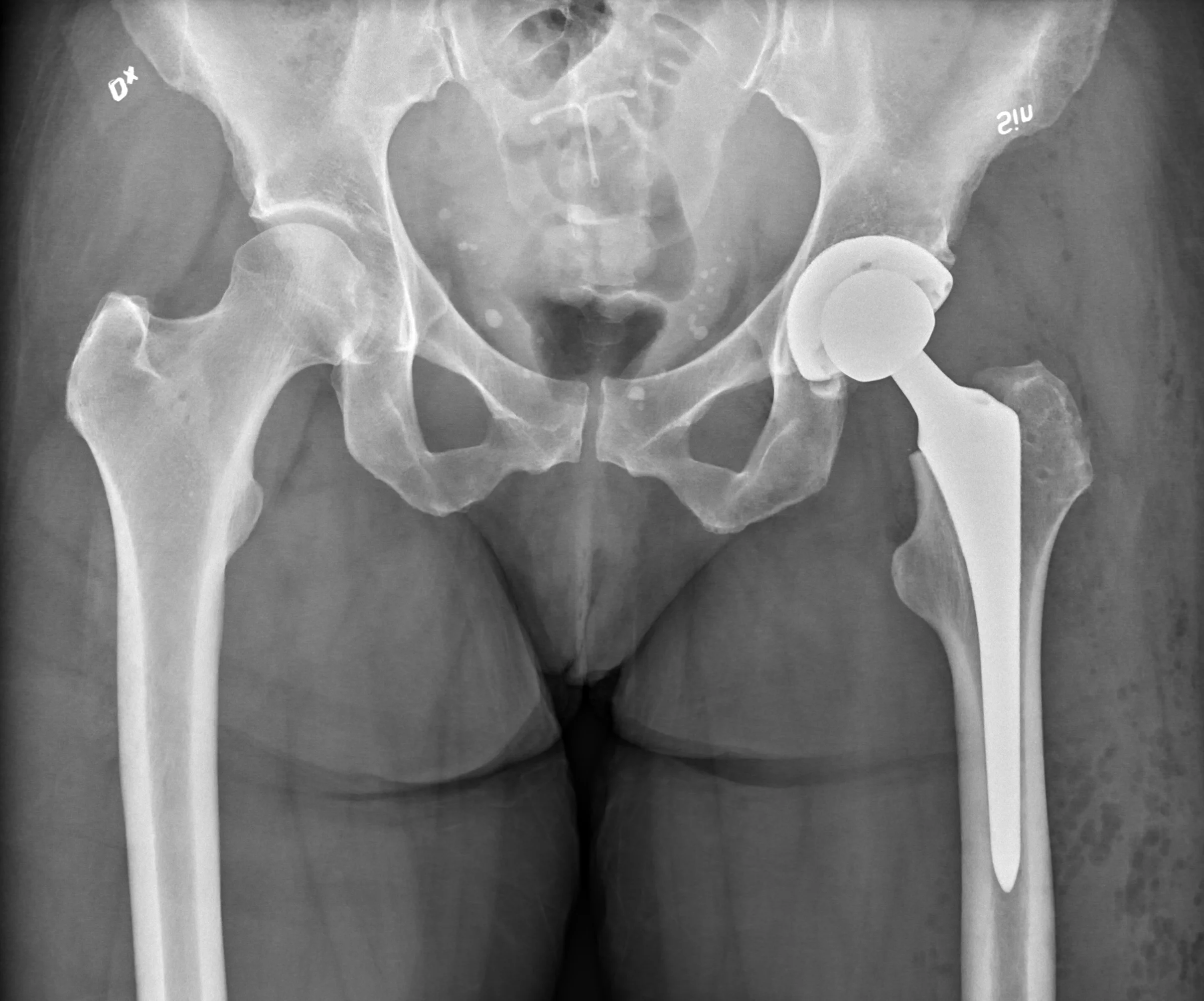 Radiografia AP da bacia com prótese total moderna do quadril esquerdo (não cimentada, cabeça esférica) — quadril direito nativo